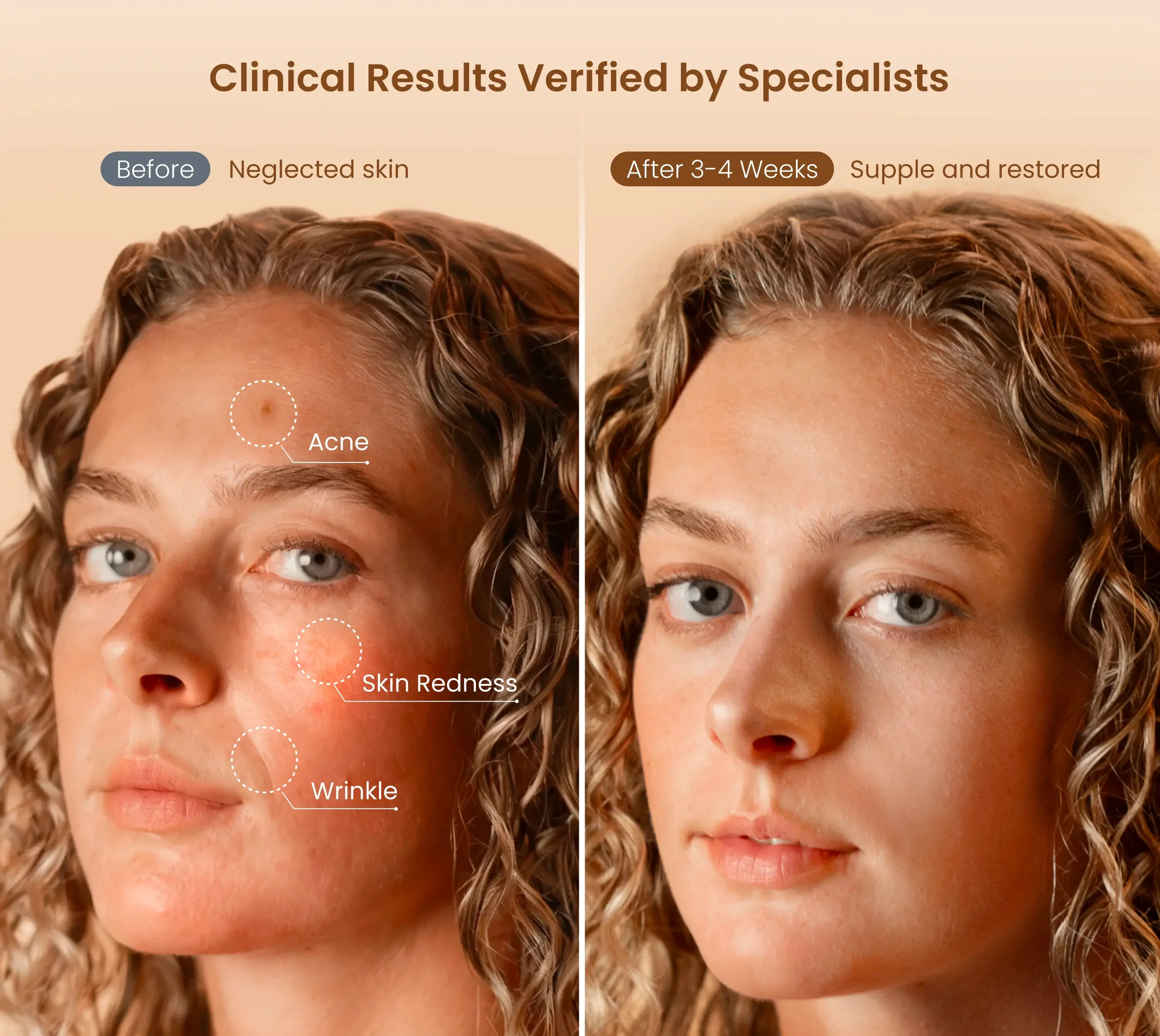 Artemis LED Light Therapy Mask - Image 5